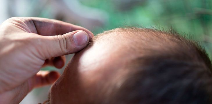 suggerimenti per il trapianto di capelli