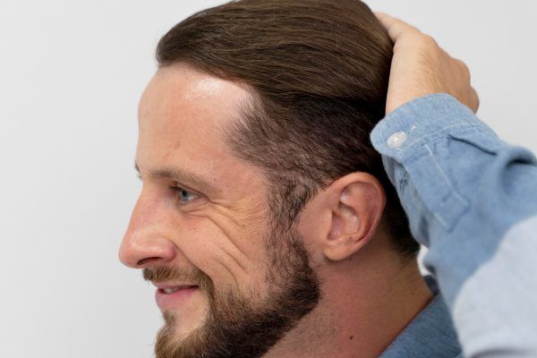 uomo che si tocca i capelli concetto calvizie