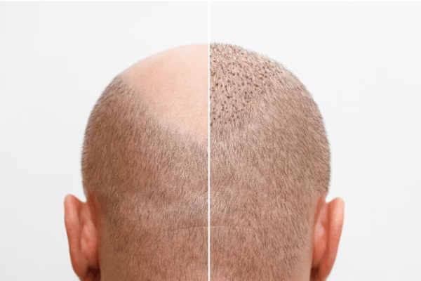 La testa di un uomo calvo prima e dopo l'intervento di trapianto di capelli un uomo che perde i capelli è diventato