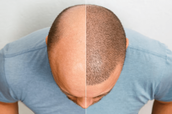 uomo con trapianto di capelli appena effettuato - trapianto capelli Roma prezzi
