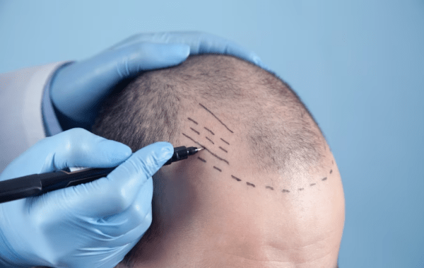 Come recuperare i capelli?