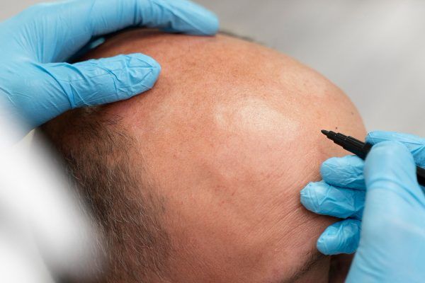 Soluzioni per te in Turchia e senza cicatrici sul cranio.