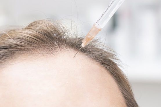 trattamento contro la caduta di capelli PRP