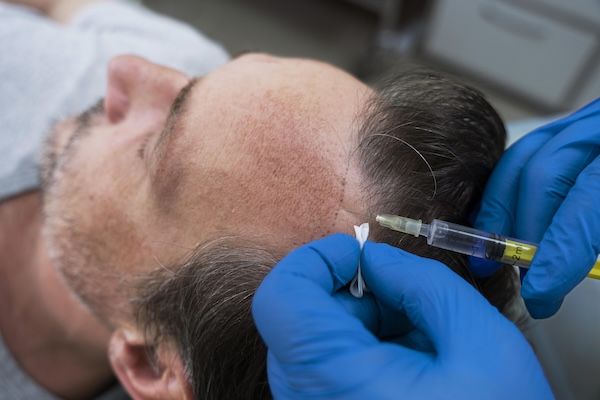 Uomo che riceve un trattamento per la caduta dei capelli.