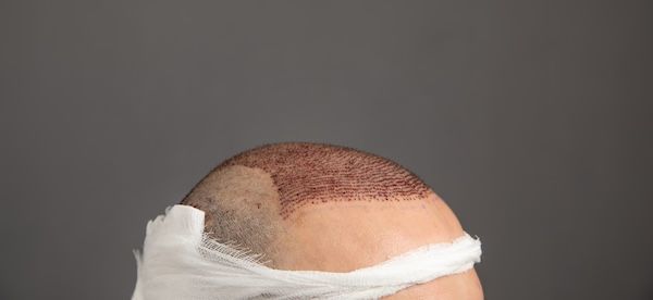 Uomo dopo un trapianto di capelli FUE