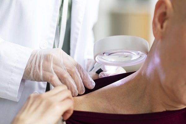 Psoriasi del cuoio capelluto: cause, sintomi e trattamenti