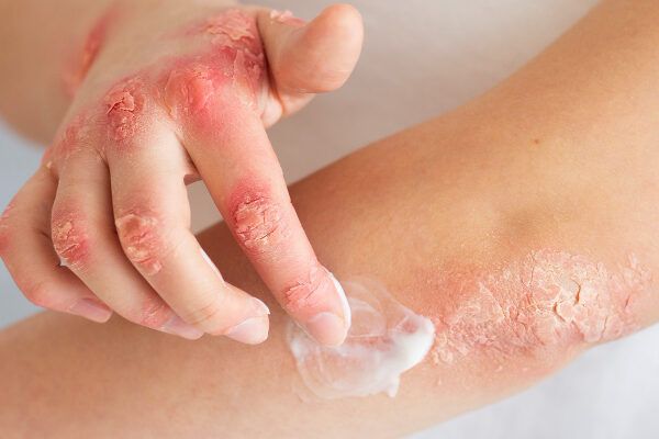 Causa del lichen planus pilare da dermatite.