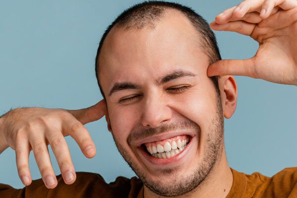 Giovane con alopecia areata che sorride e si tocca i capelli - Carie e calvizie sono correlate?