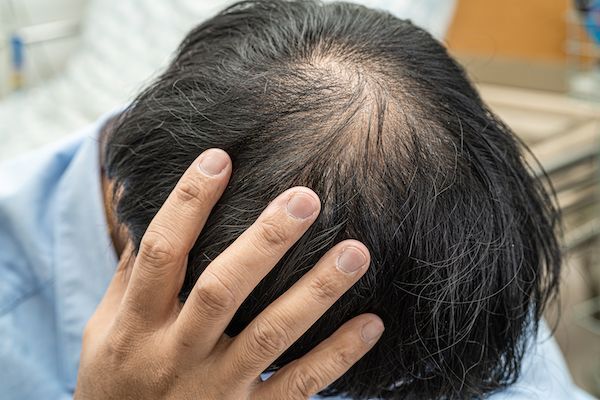 Cuoio capelluto di un uomo affetto da alopecia areata.