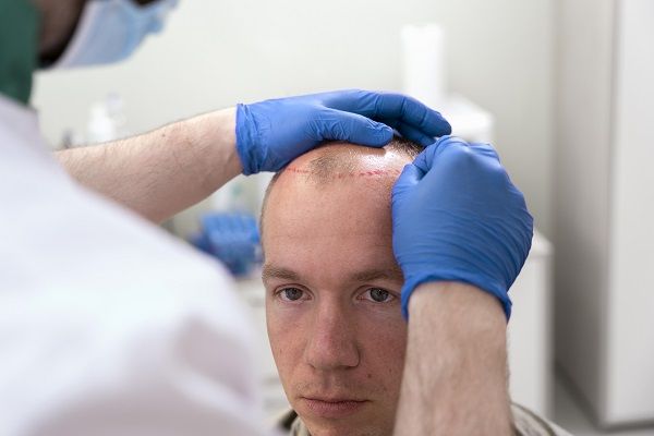 uomo che si sottopone ad un trapianto di capelli in Turchia