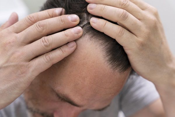 uomo che si tocca il cuoio capelluto e si accorge di avere meno capelli - trapianto capelli cicatrici