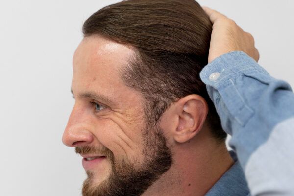 Uomo adulto con occhi chiari che mostra il suo profilo sorridente mentre gli accarezza i capelli all'indietro - Fase crescita dei capelli.