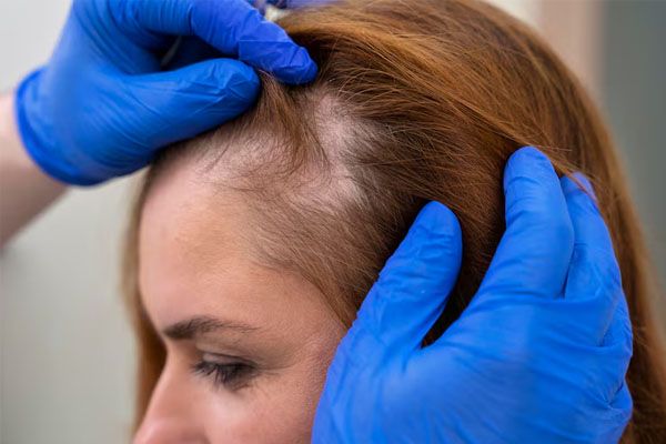 donna che riceve una clinica per il trattamento della caduta dei capelli