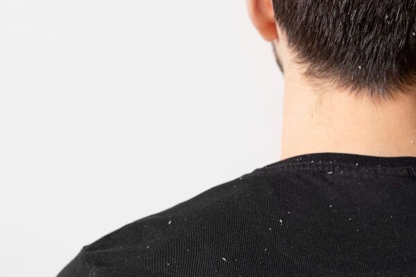 Uomo in flanella nera sdraiato sulla schiena con forfora sulle spalle - Come trattare la forfora negli uomini