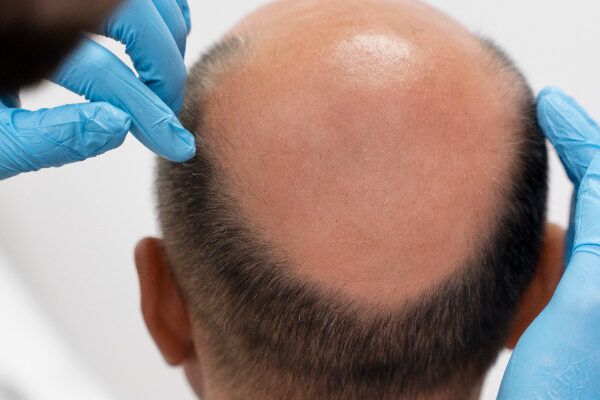 Medico con guanti chirurgici che controlla un paziente con alopecia.