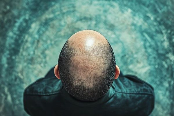 vista dall'alto della testa di un uomo con i capelli corti su uno sfondo blu