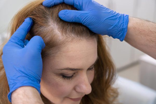 donna con professionalista di capelli per trapianto capillare - Trapianto capelli donna senza rasatura