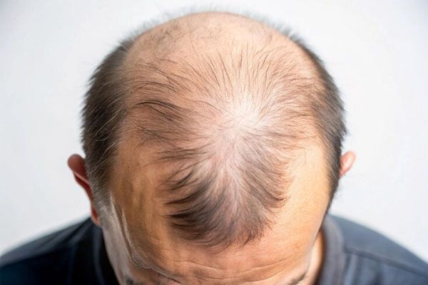 primo piano di una testa con alopecia