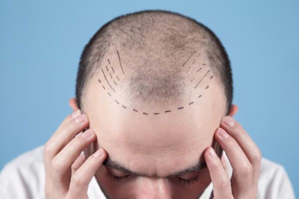 uomo senza capelli concetto trapianto capelli - trapianto capelli Italia Roma