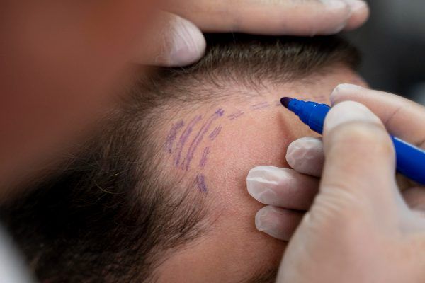 preparazione preliminare per un trattamento per capelli - miglior trapianto capelli Italia