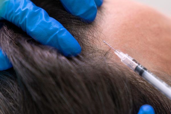 siringa sulla fronte del paziente - trapianto capelli italia 