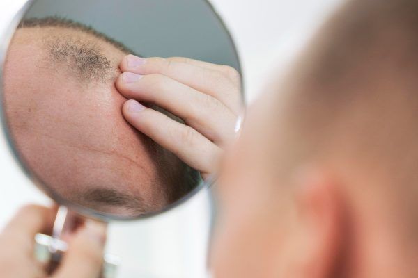 uomo calvo caduta di capelli