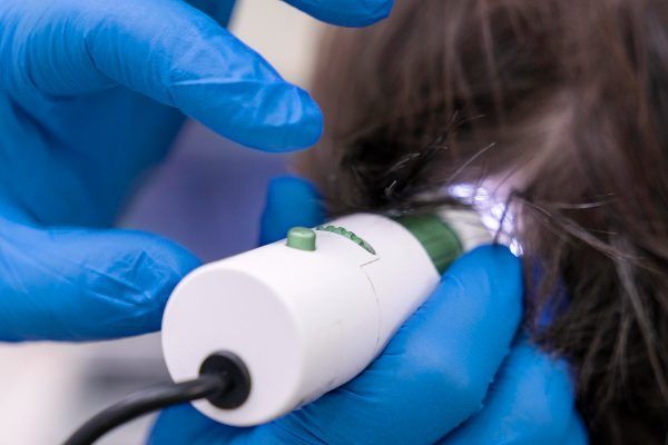Donna sottoposta a trattamento per la caduta dei capelli