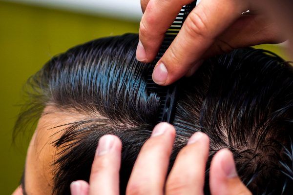 Il trattamento migliore per l’alopecia androgenetica.