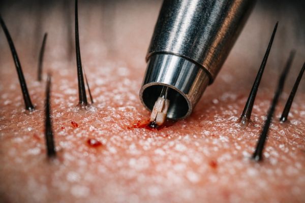 Il processo di estrazione dei follicoli con microincisioni
