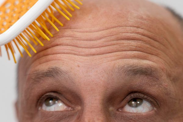 A che età è normale la caduta dei capelli?