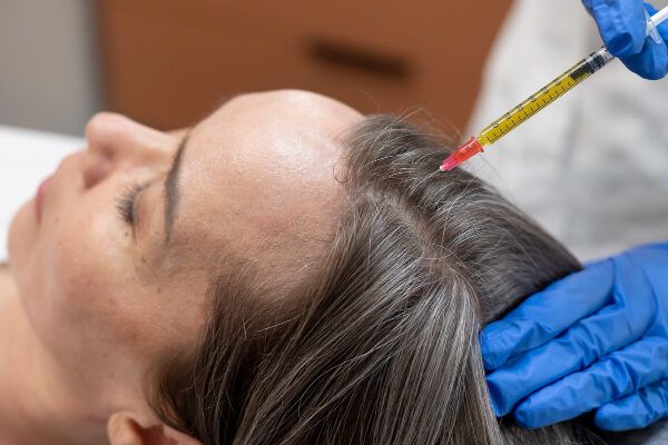 Primo piano della testa di una donna e delle sue mani guantate che tengono una siringa - Trapianto Capelli, Italia