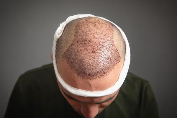 Uomo caucasico dopo trapianto di capelli