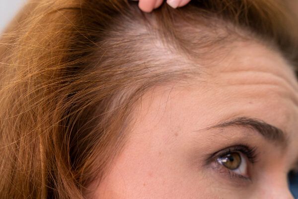 Alcune delle tue probabili cause di alopecia nella zona frontale.