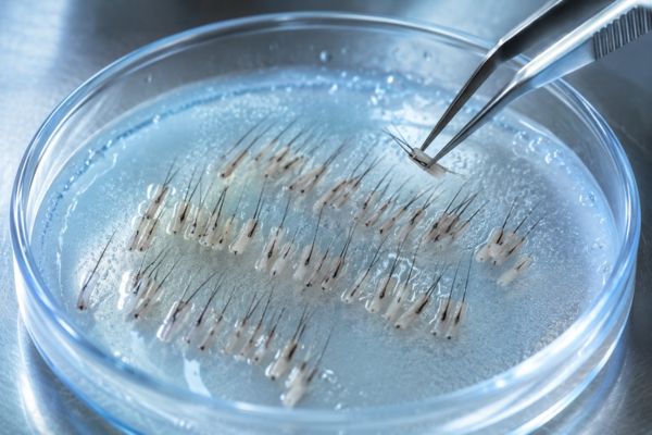 Unità follicolari estratte e conservate in una soluzione nutritiva prima dell'innesto tricologico.