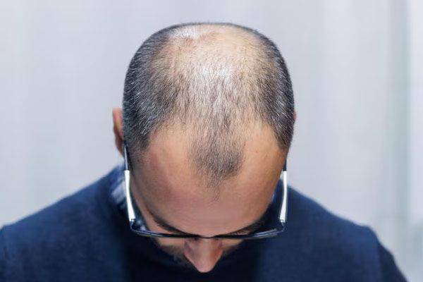 Primo piano di un uomo con alopecia con la testa abbassata