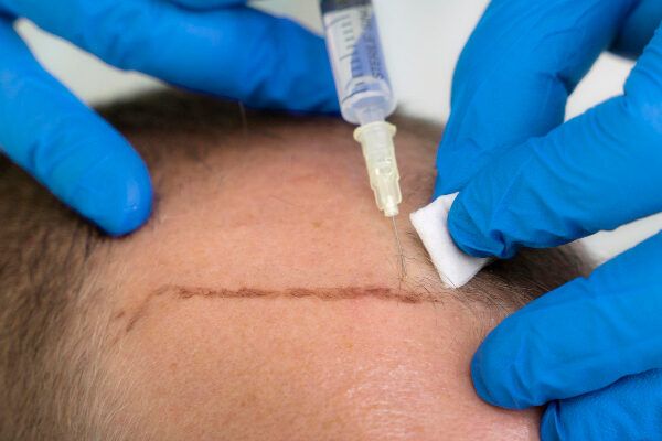 Risultati di un PRP per capelli.