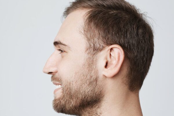 Profilo di giovane uomo sorridente con barba e alopecia areata - Fermare l'alopecia giovanile?
