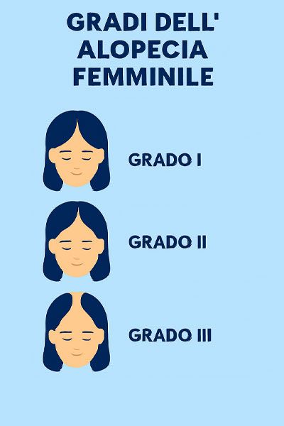 gradi dell alopecia femminile