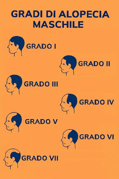 gradi di alopecia mashchile