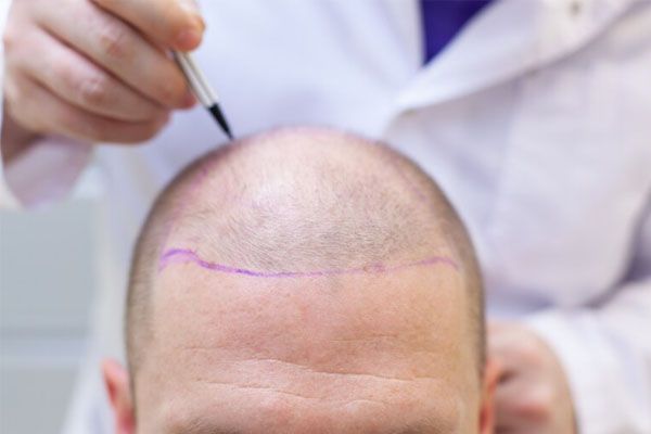 preparazione-all'intervento-di-trapianto-di-capelli
