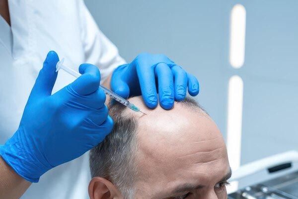 uomo-anziano-sottoposto-a-trattamento-per-capelli