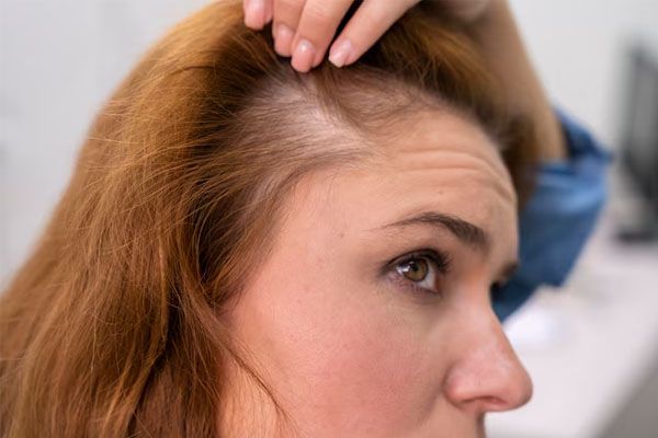 donna che mostra la zona con alopecia