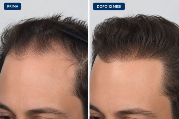 Immagine comparativa ravvicinata della linea frontale di un uomo prima e dopo un trapianto capillare di successo